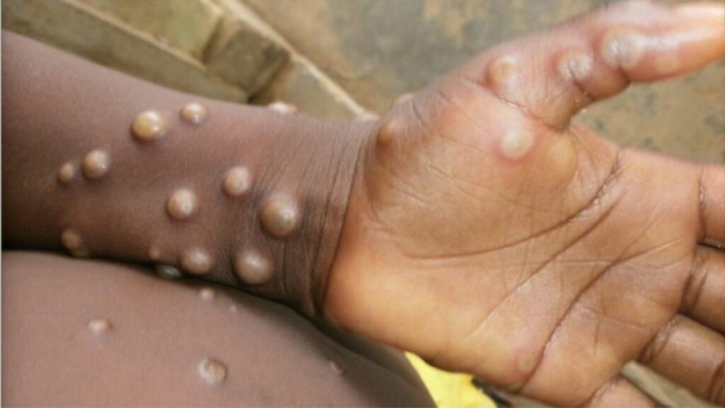 मंकीपॉक्स क्या है (What is monkeypox in Hindi)और इसका लक्षण (What are the symptoms of monkeypox)