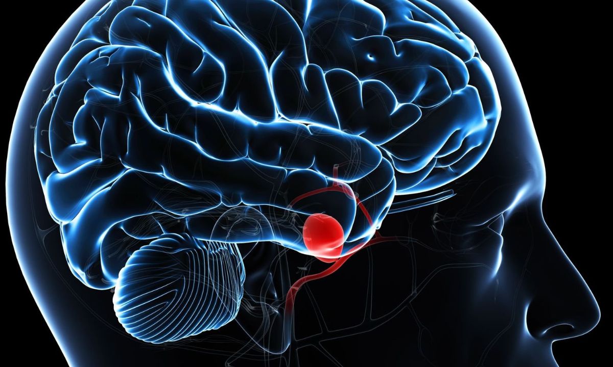 Brain Aneurysm causes and symptoms